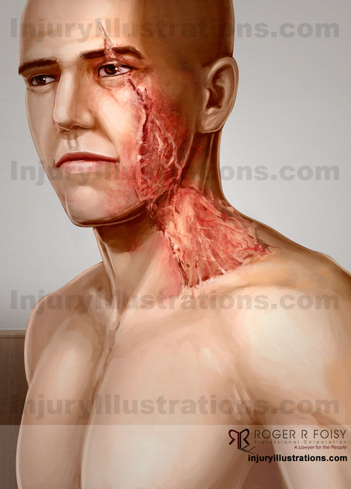 Compensating for the Emotional and Psychological Impact of Scar, Burn, and/or Disfigurement Injuries