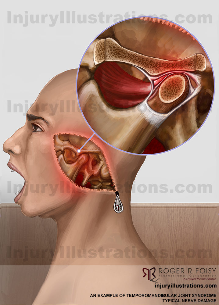 Temporomandibular Joint (TMJ) Disc Displacement