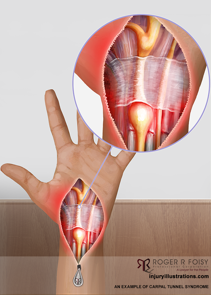 Carpal tunnel syndrome