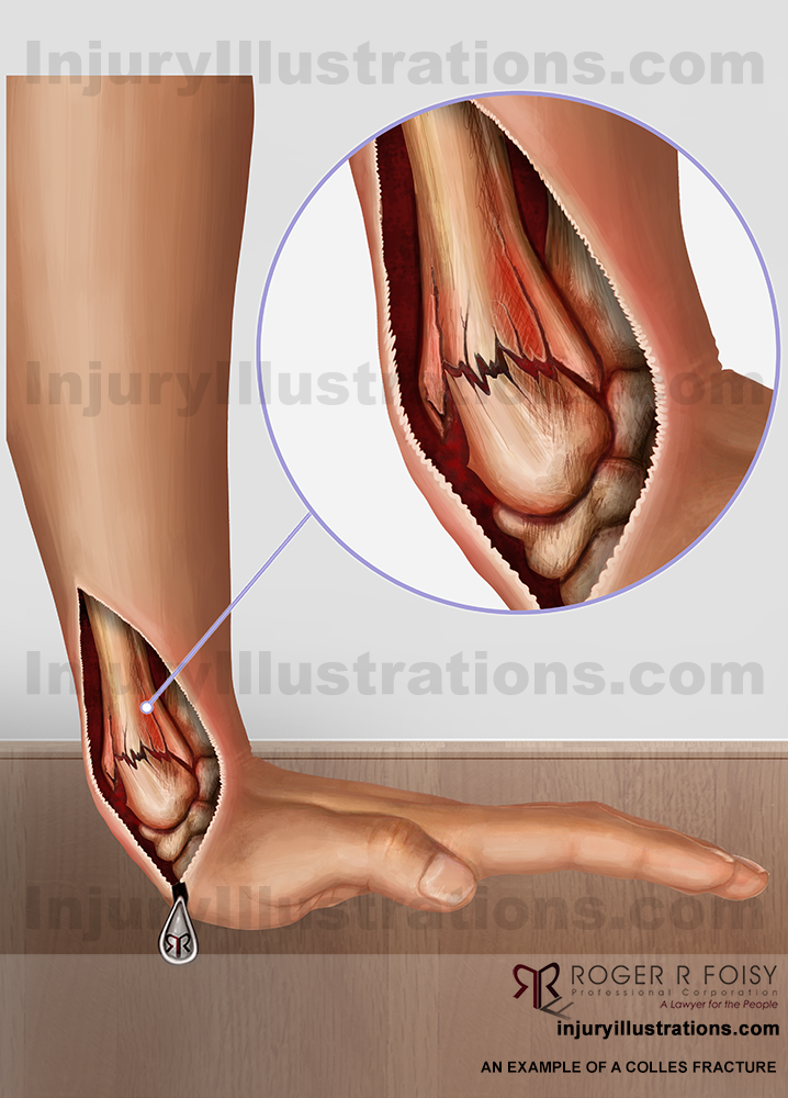 Colles fracture