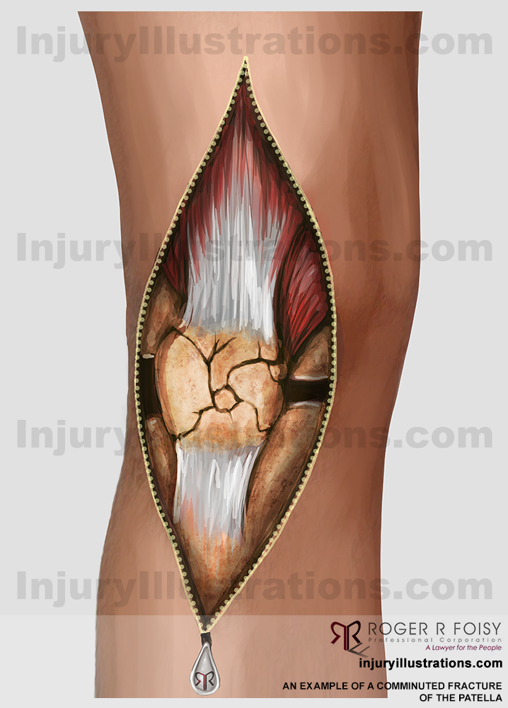 Potential Settlement Value For Comminuted Fracture of the Patella