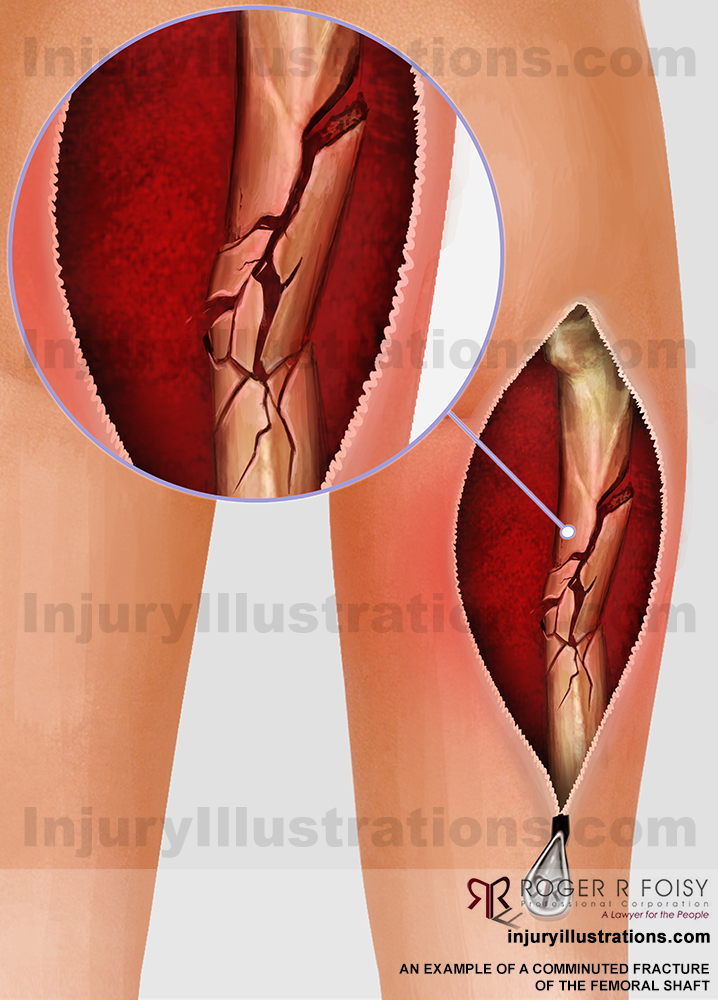 Comminuted fracture of the femoral shaft