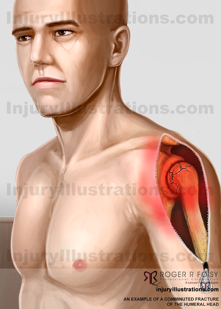 Comminuted fracture of the humeral head