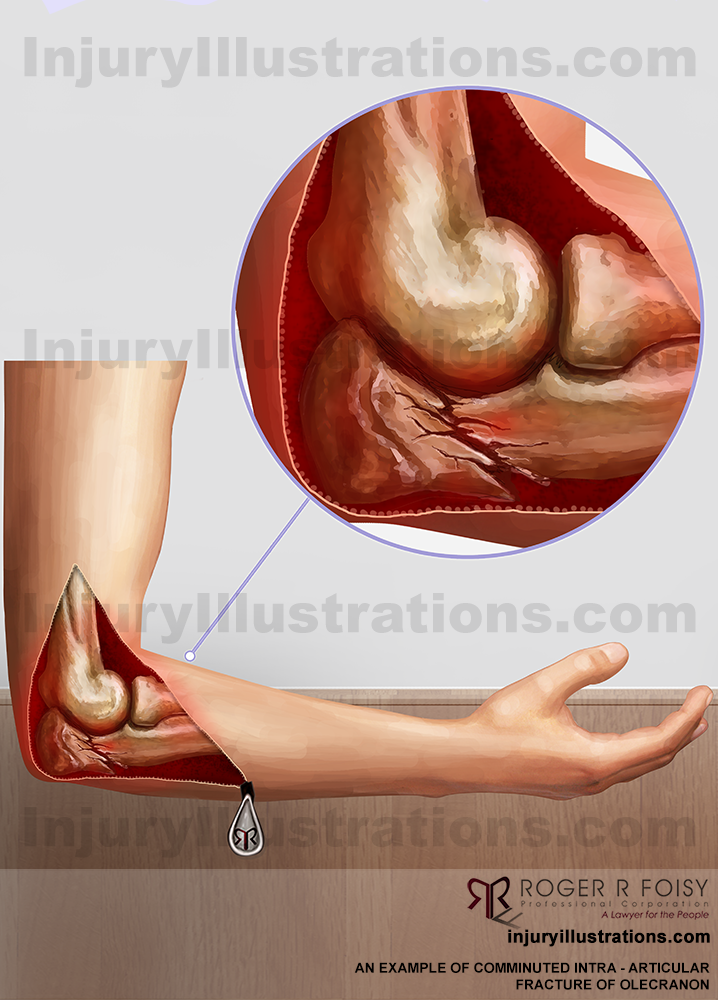 Comminuted intra-articular fracture of the olecranon