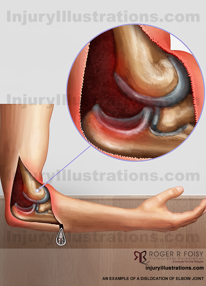 Dislocation of elbow joint