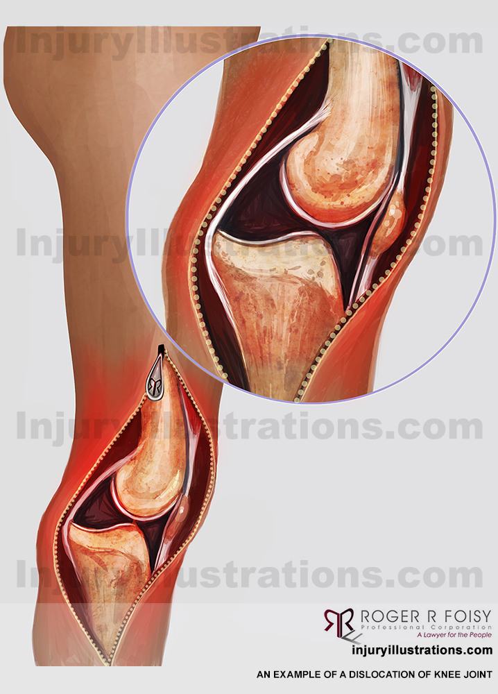 Dislocation of knee Joint – lateral view 