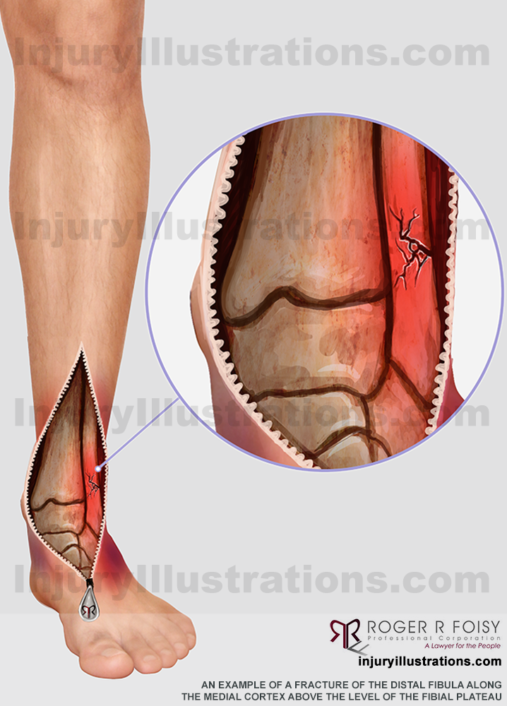 Fracture of distal fibula along the medial cortex above the level of the fibial plateau