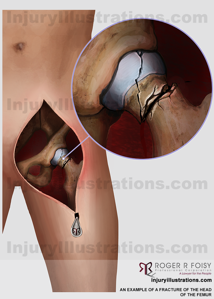 Fracture of the head of the femur