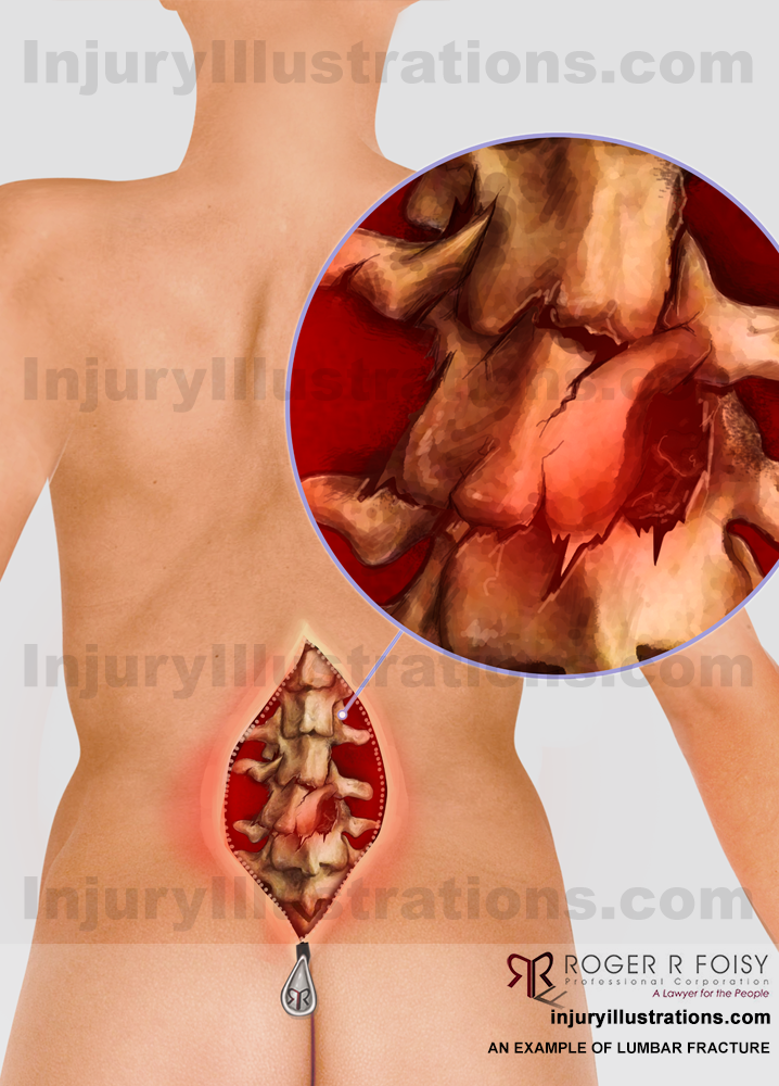  Lumbar Fracture