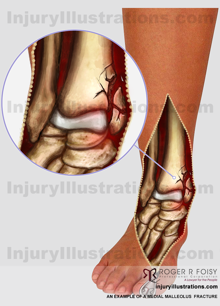 Medial malleolus  fracture