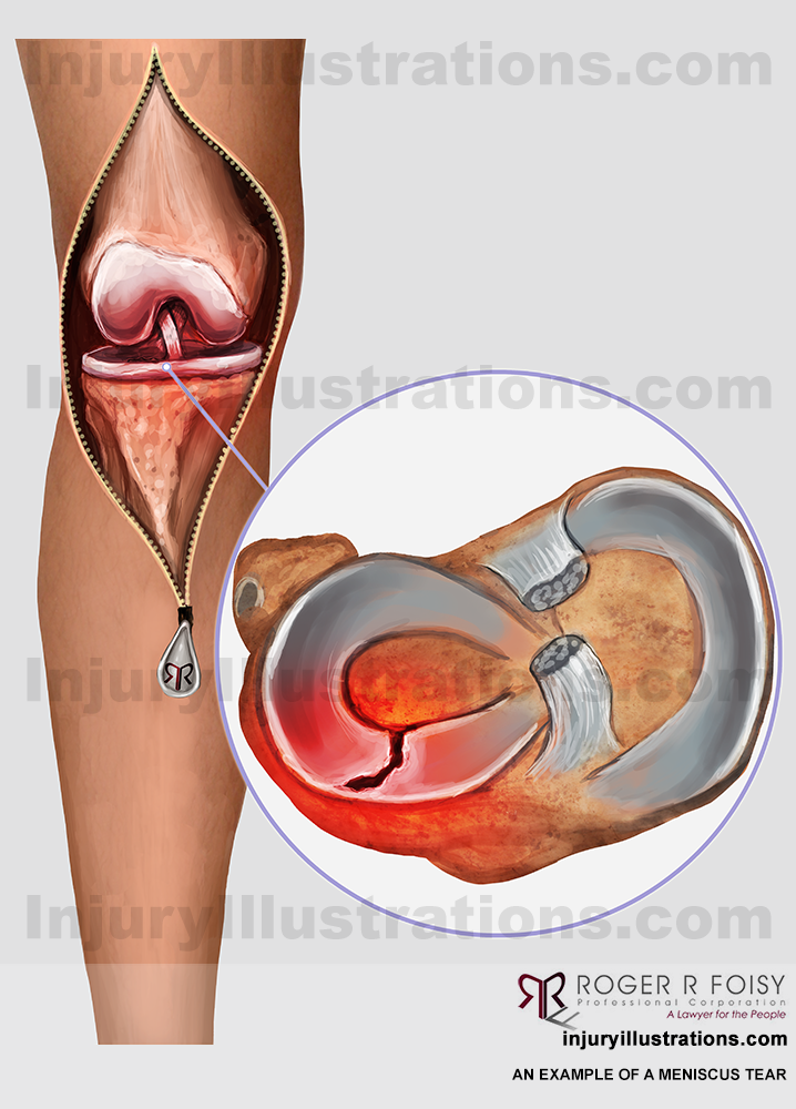 Meniscus Tear