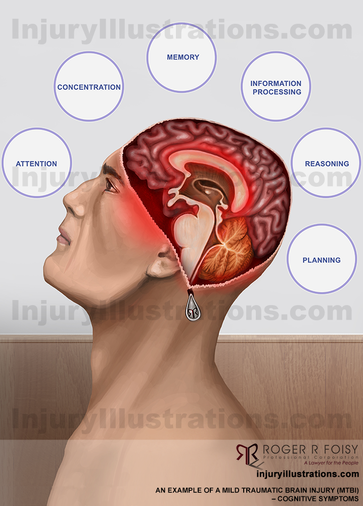 Mild Traumatic Brain Injury (MTBI) or Concussion  – Cognitive Symptoms