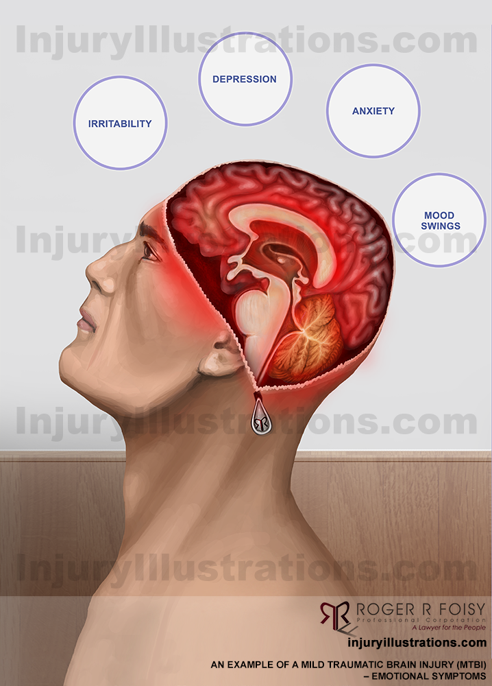 Mild Traumatic Brain Injury (MTBI) or Concussion -  Emotional Symptoms