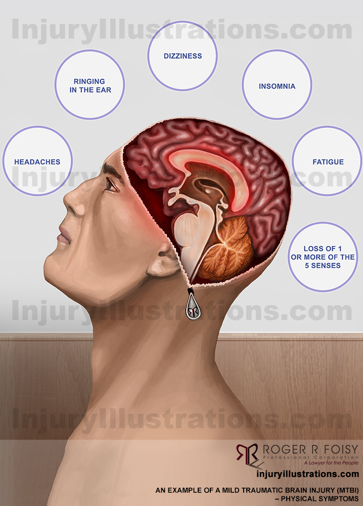 Mild Traumatic Brain Injury (MTBI) or Concussion – Physical Symptoms
