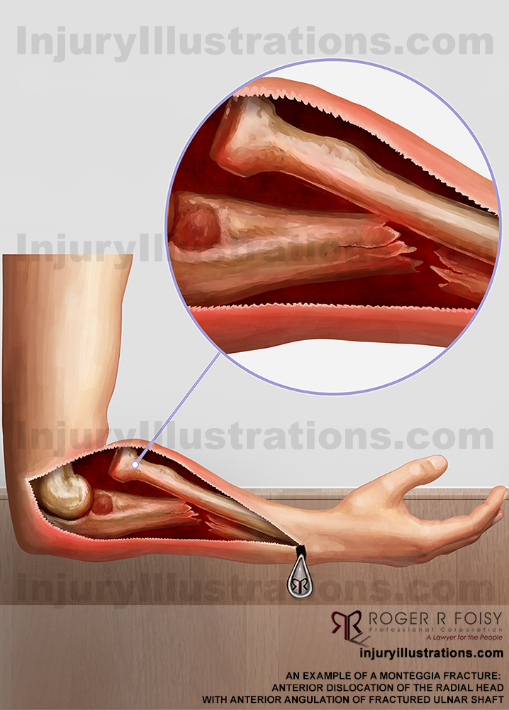 Monteggia fracture