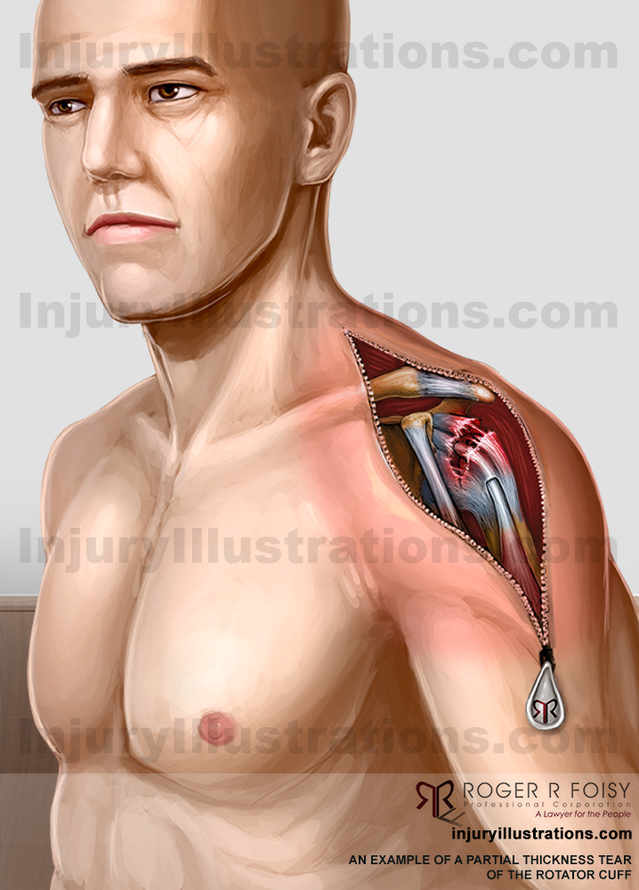 Partial thickness shoulder tear