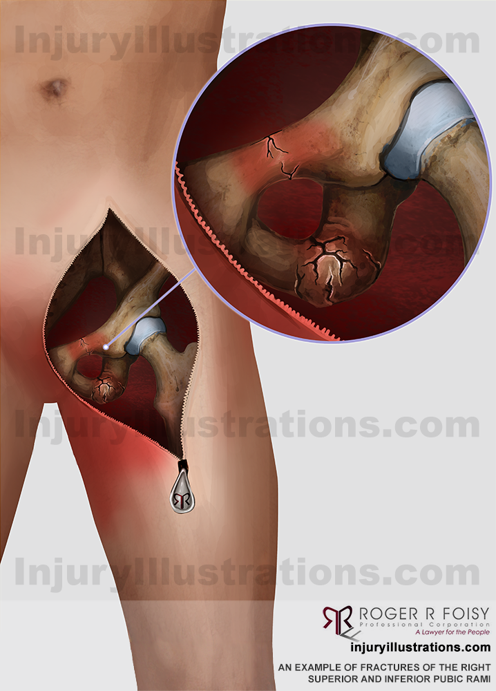 Right superior fracture and inferior pubic rami