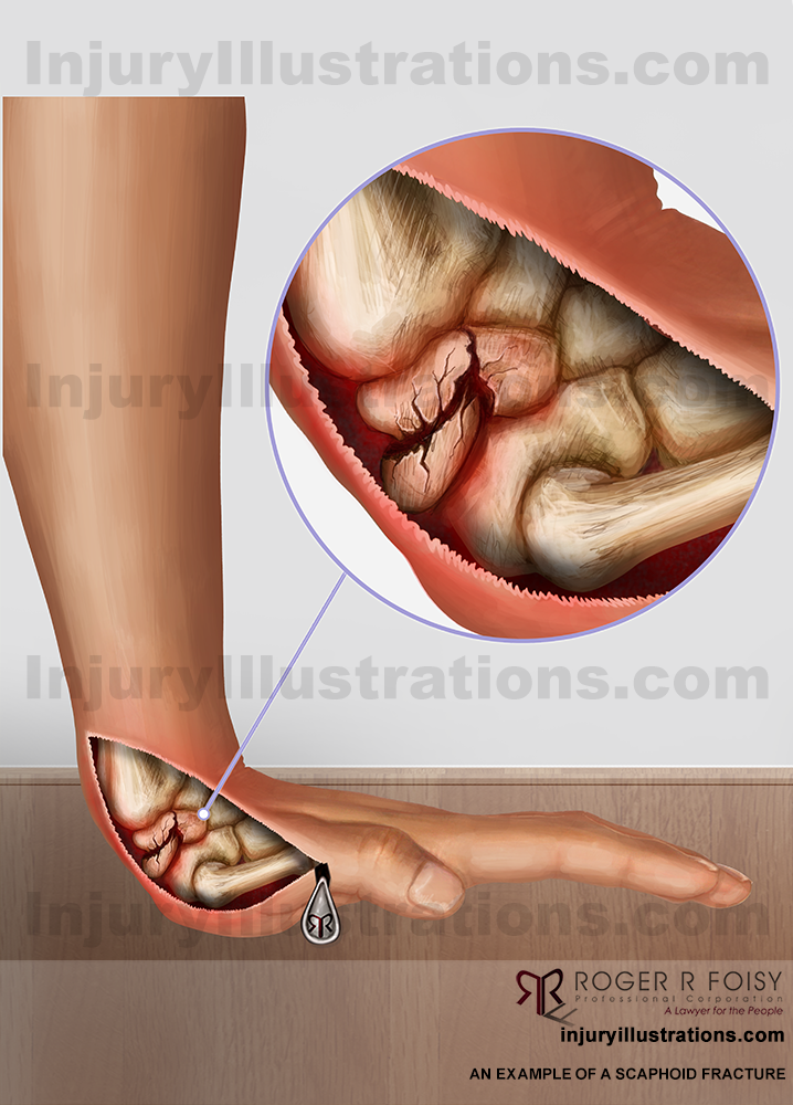 Scaphoid fracture