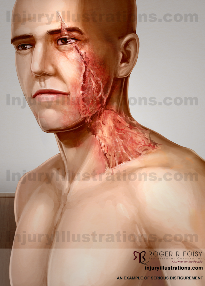 Scarring and disfigurement side of face and neck