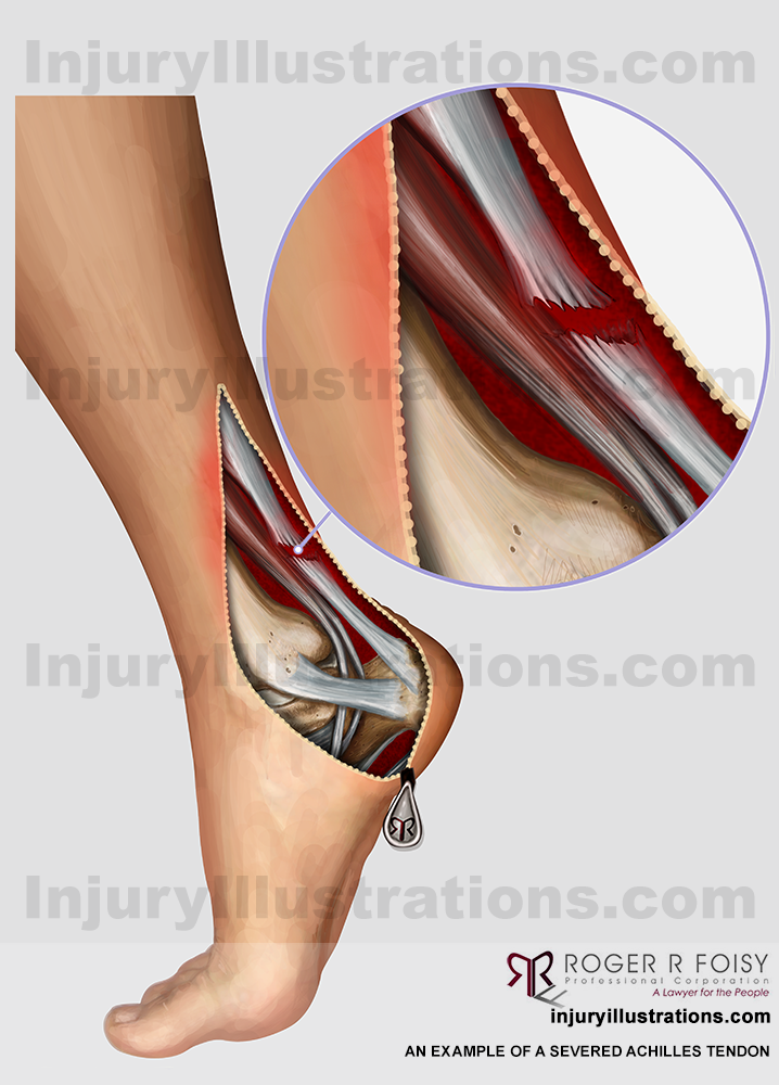 Severed Achilles tendon