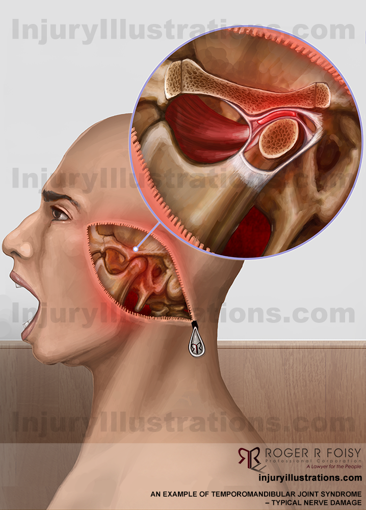 Temporomandibular Joint Syndrome (TMJ). Typically nerve damage