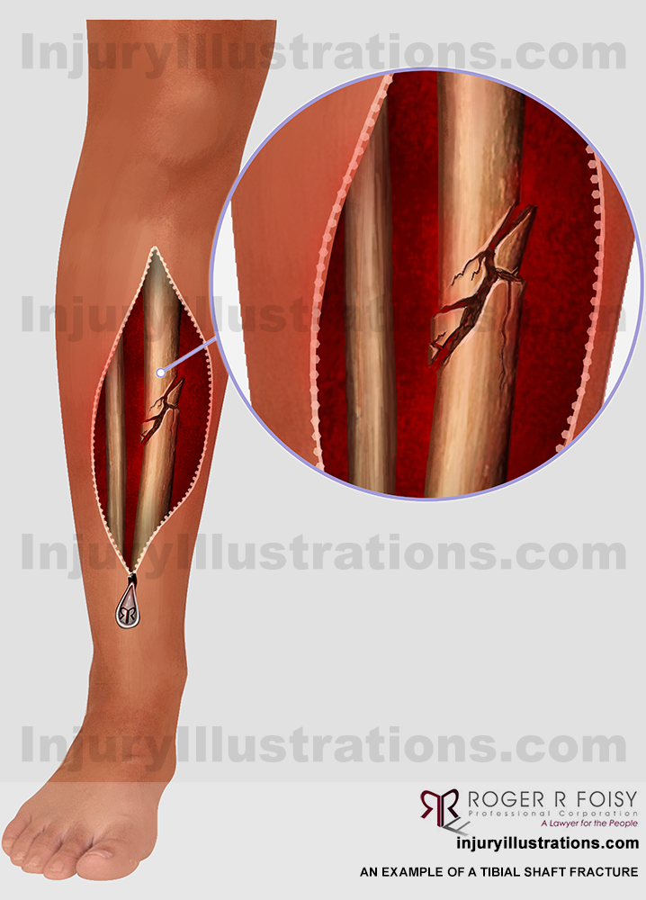 Tibial shaft fracture