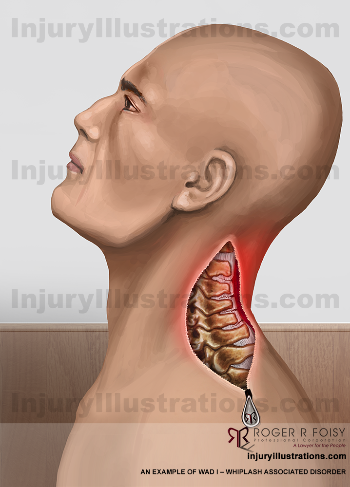  WAD – Whiplash Associated Disorder I