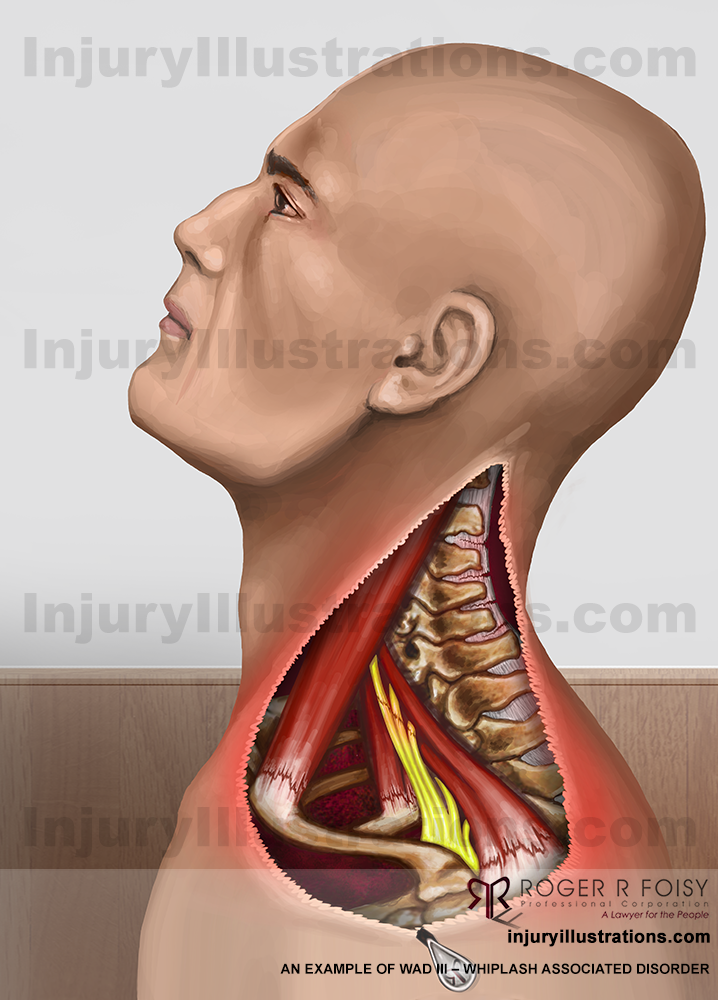 WAD – Whiplash Associated Disorder III