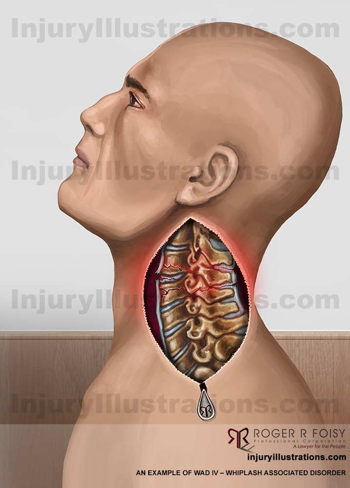 WAD – Whiplash Associated Disorder IV