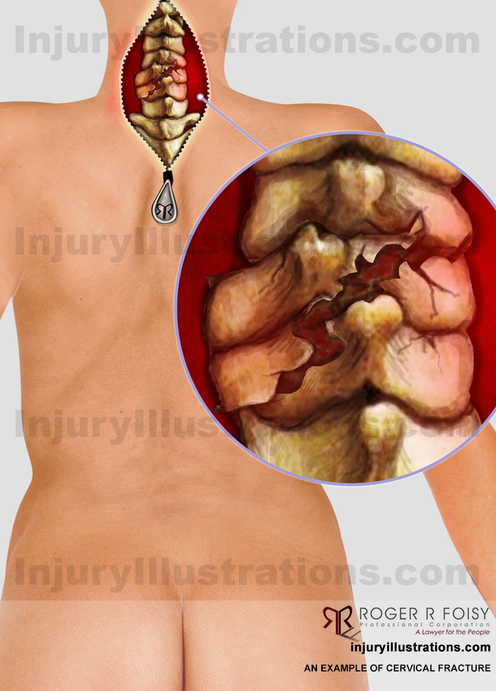 Back – Cervical Fracture C5/C6