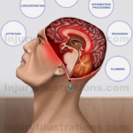 Mild Traumatic Brain Injury – Cognitive Symptoms
