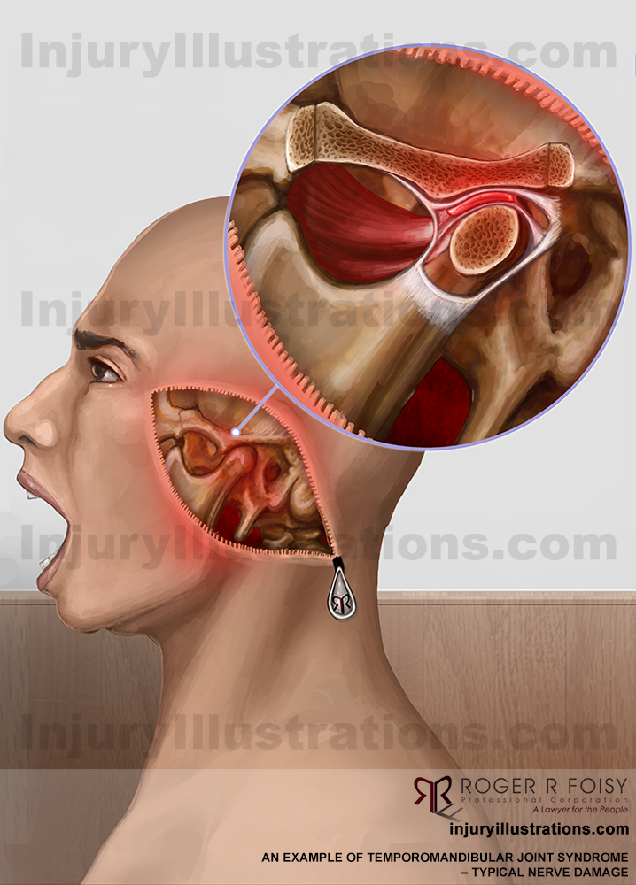 Temporomandibular Joint Syndrome (TMJ)