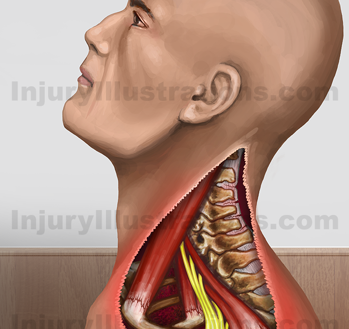 Personal Injury Potential Settlement Values: Whiplash Injuries