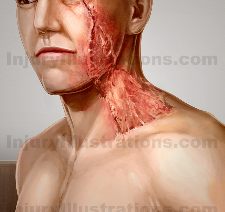Personal Injury Potential Settlement Values: Scarring and Disfigurement of the Face and Neck