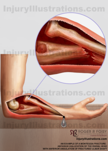 Monteggia fracture anterior dislocation of the radial head with anterior angulation of fractured ulnar shaft Settlement Value