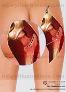 Intertrochanteric Fracture Diagram