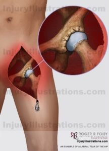 Labral Tear of the Hip Diagram