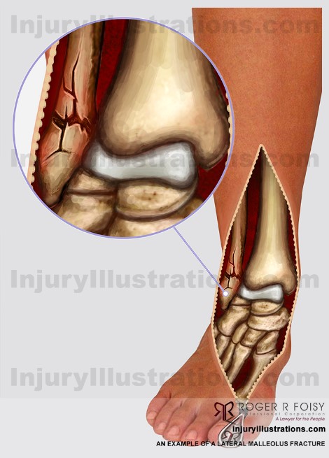 Personal Injury Potential Settlement Values Leg And Ankle Injuries