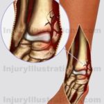 Medial Malleolus Fracture