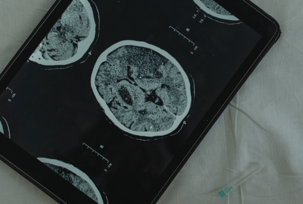 Coping with the Emotional and Psychological Impact of a Mild Traumatic Brain Injury