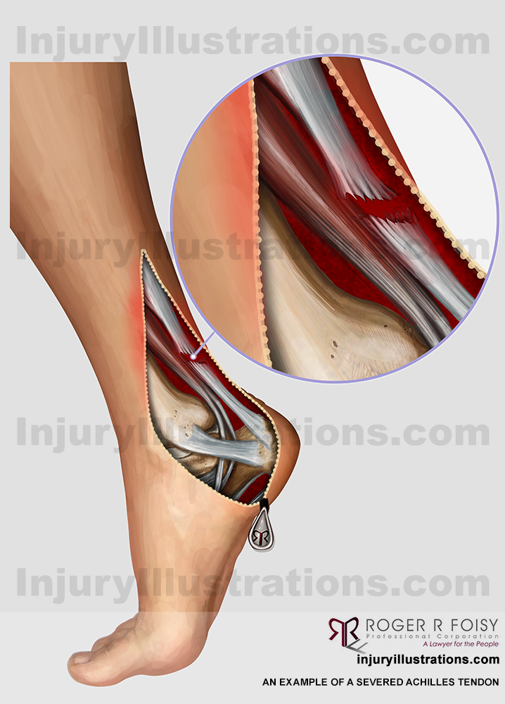 Severed Achilles Tendon