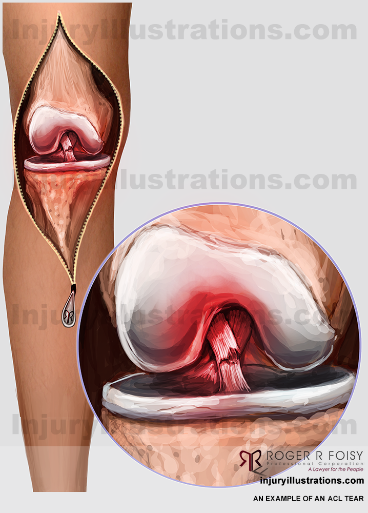 ACL Tear
