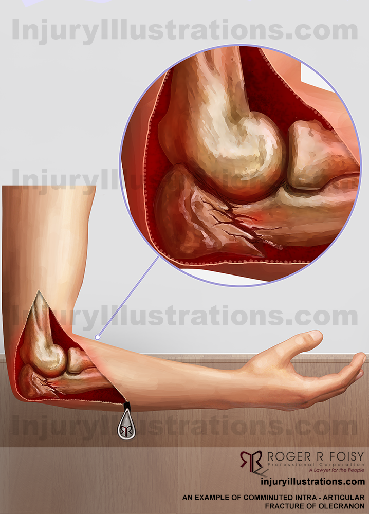 Comminuted Intra-Articular Fracture of the Olecranon