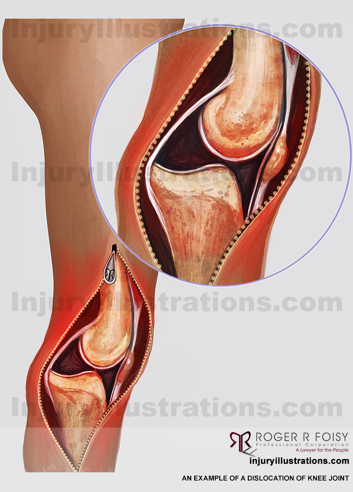 Dislocation of Knee Joint – Lateral View
