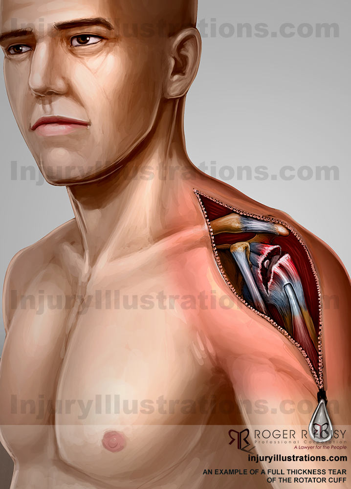 Rotator Cuff Full Thickness Tear
