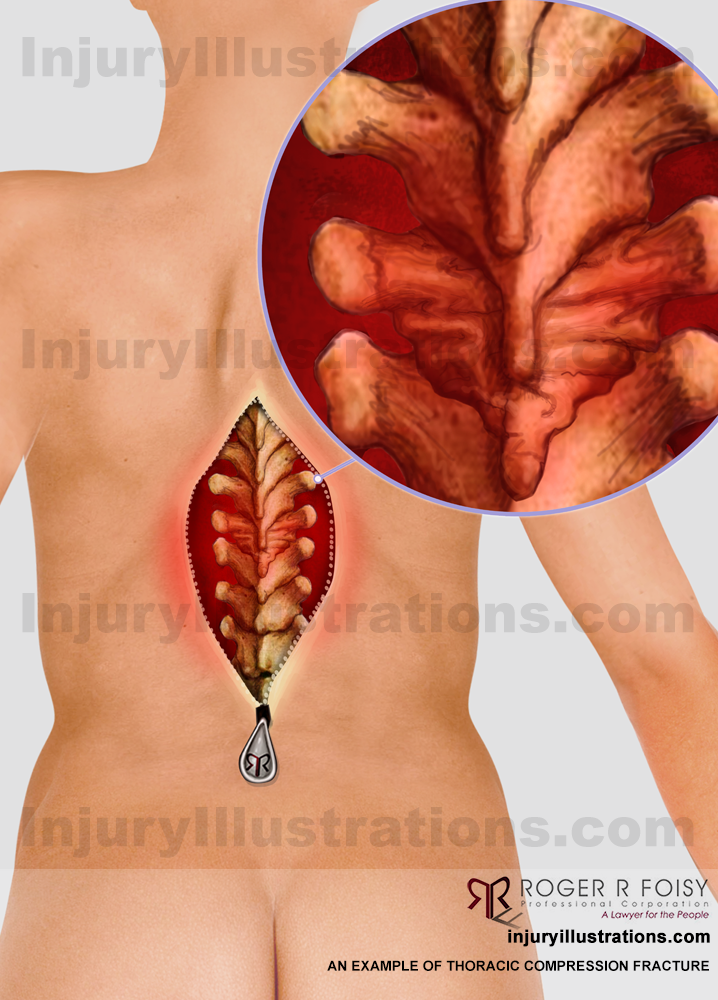 Back – Thoracic Compression Fracture – T9