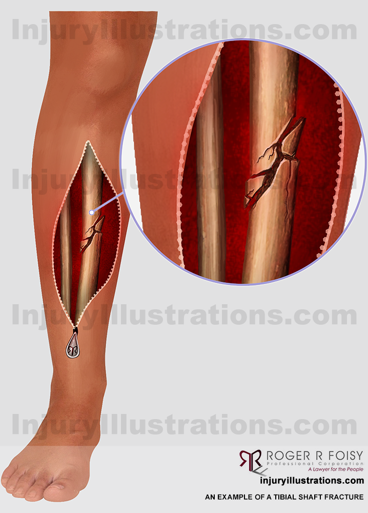 Tibial Shaft Fracture