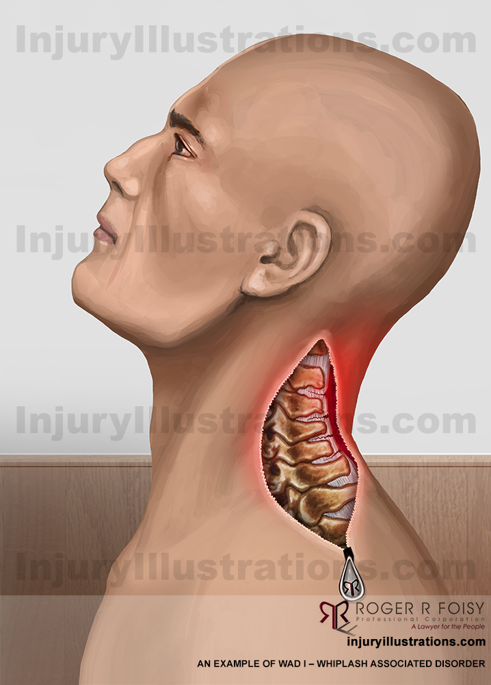 WAD – Whiplash Associated Disorder I