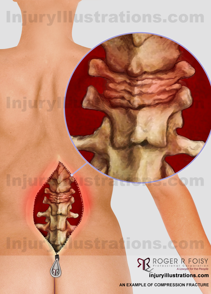 Back – Compression Fracture of L1 Vertebrae