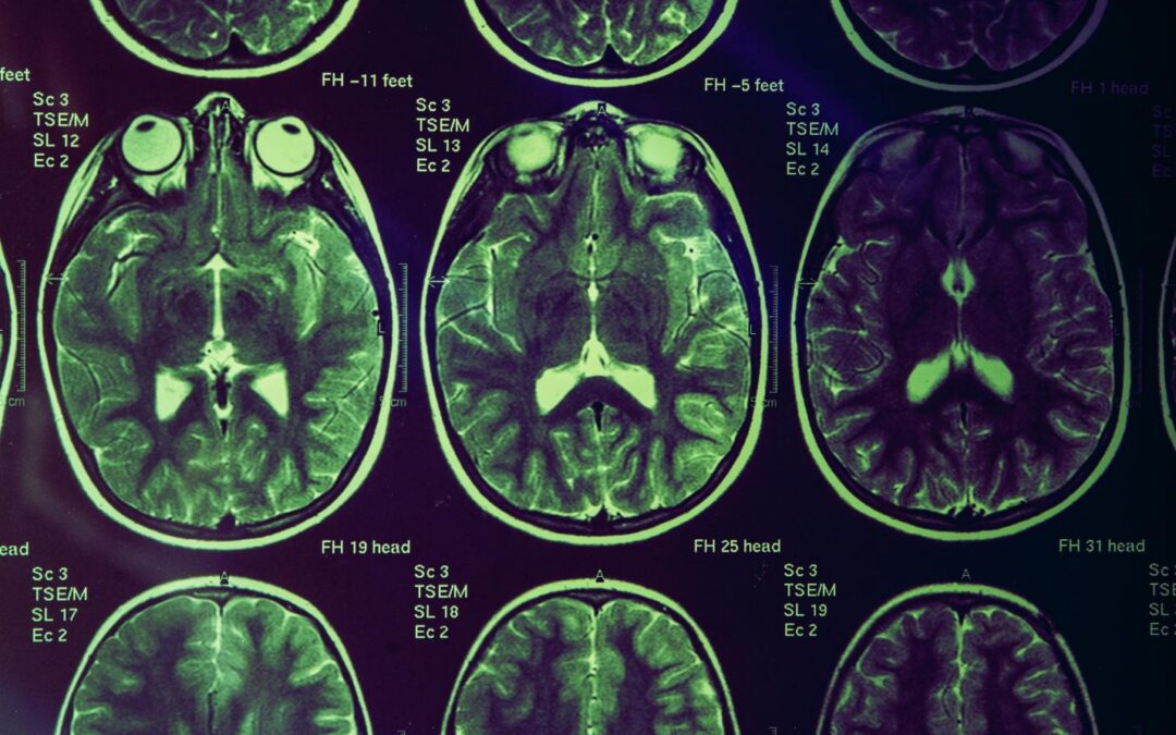 What to Know About Brain Injury Compensation and Legal Considerations